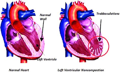 lv cardiomyopathy|what is lv noncompaction.